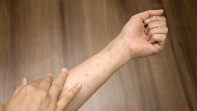 食べ物や薬によるアレルギー反応