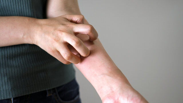 蕁麻疹の原因として考えられる主な要素